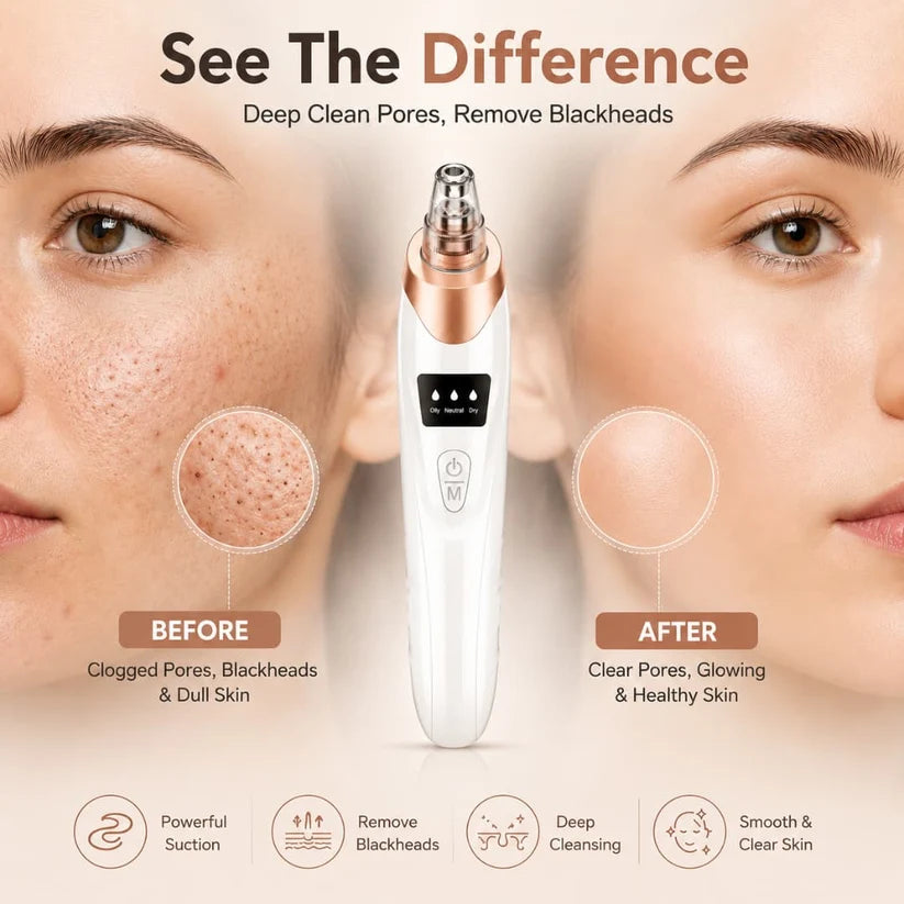 Electric Blackhead Remover – Facial Pore Vacuum